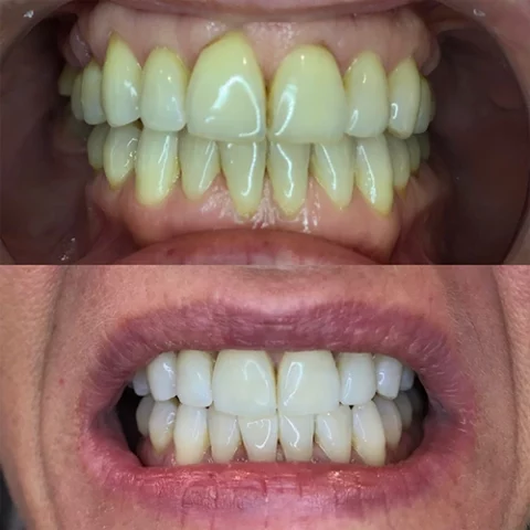 Teeth 2