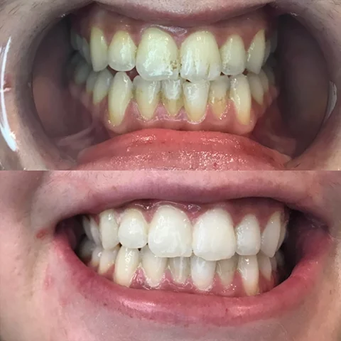 Teeth 4