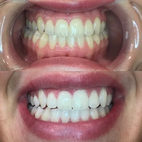 Teeth 5